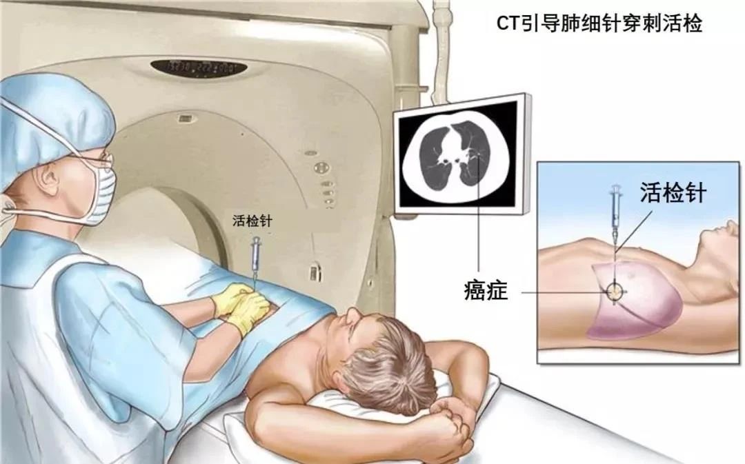 肺穿刺護理小貼士